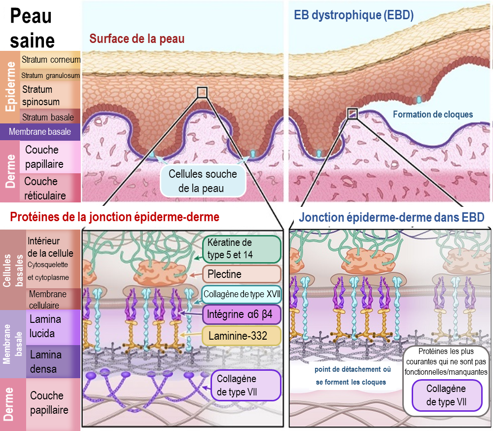 Diagram of Dystrophic EB