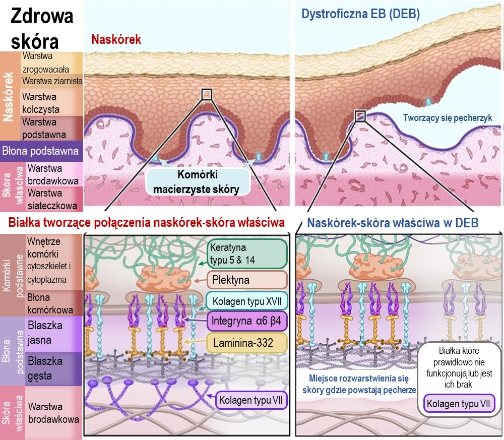 Diagram of Dystrophic EB