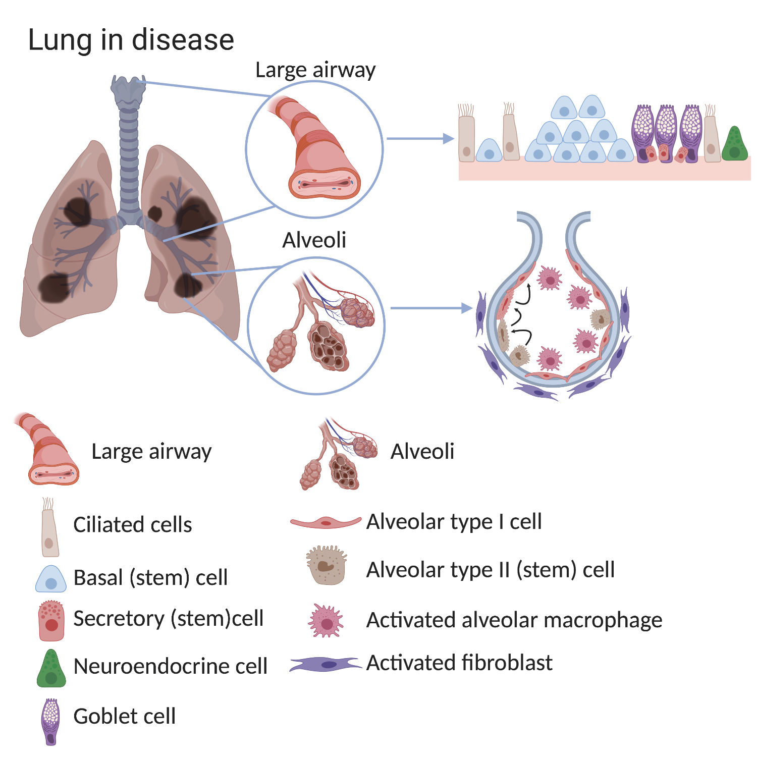 Diagram of lung affected by COPD