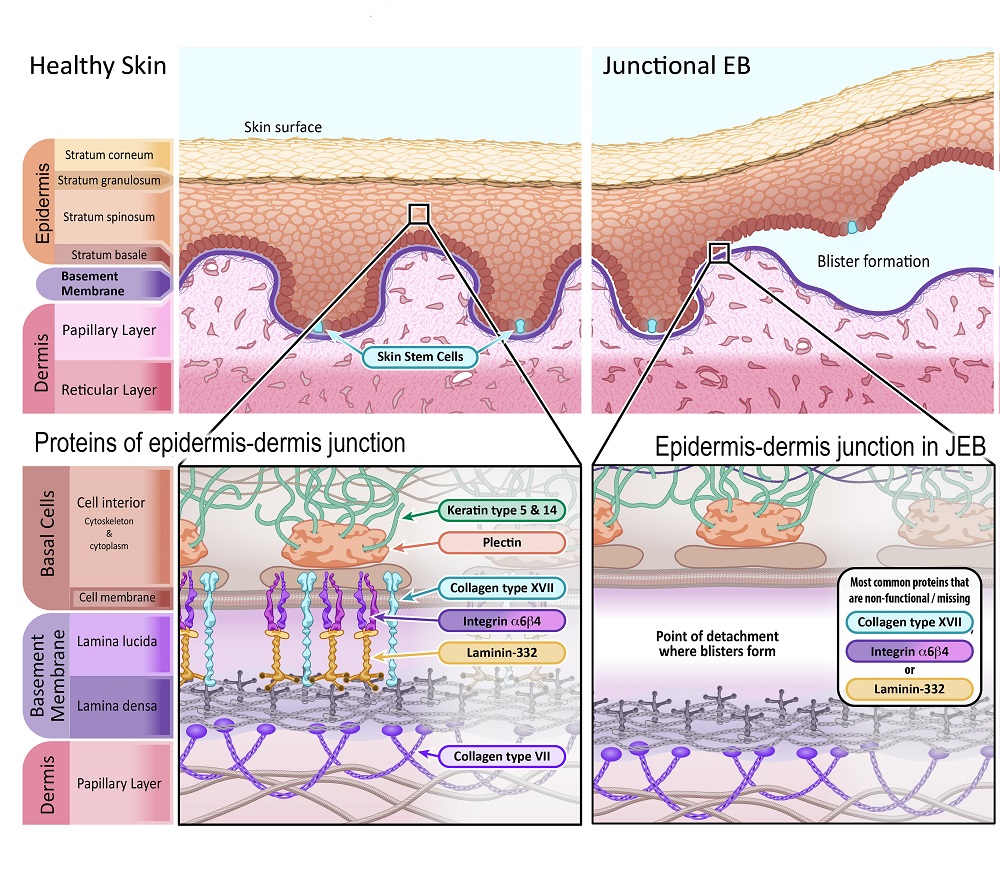 Diagram of Junctional EB