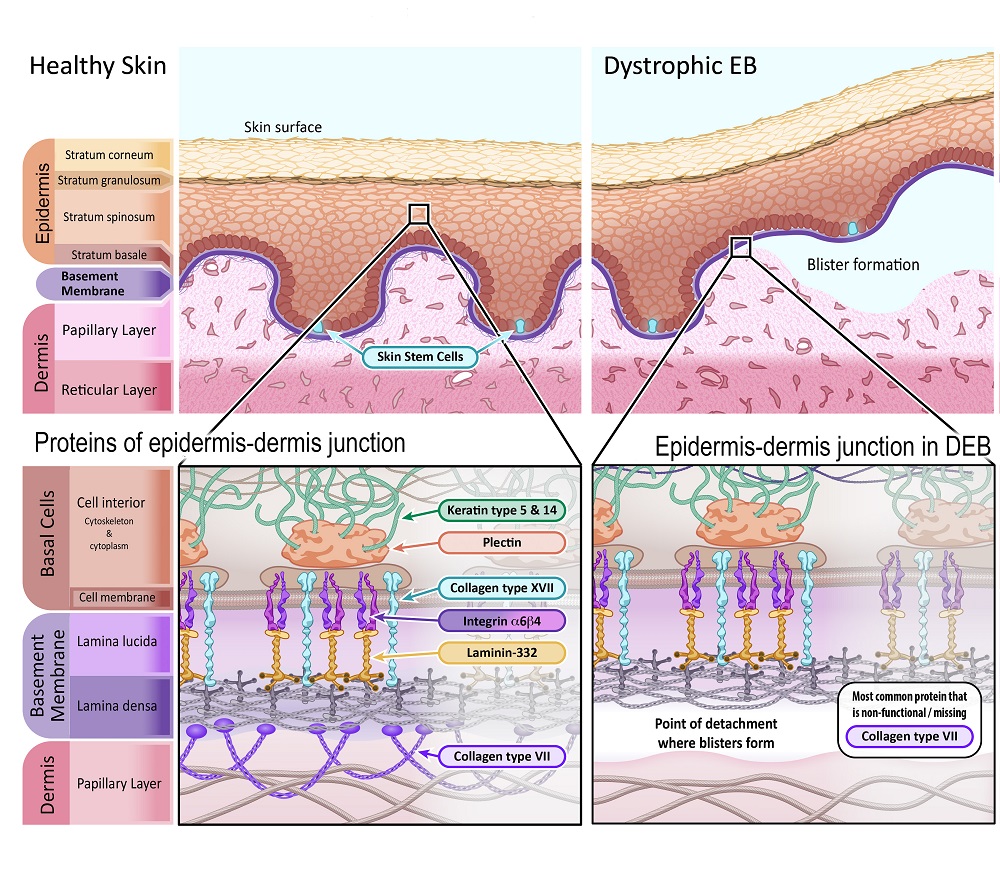 Diagram of Dystrophic EB