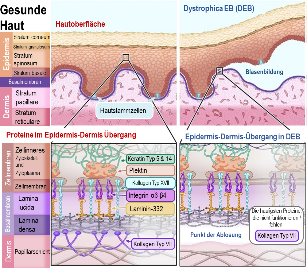 Diagram of Dystrophic EB