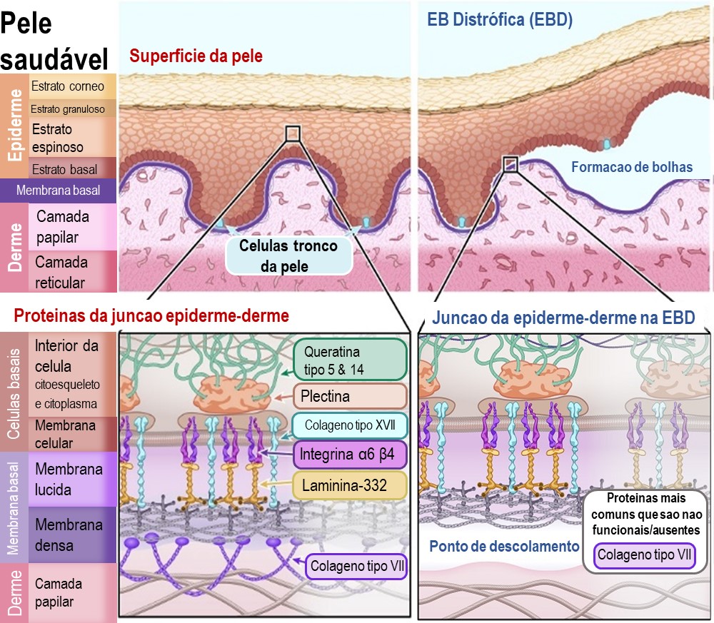 Diagram of Dystrophic EB