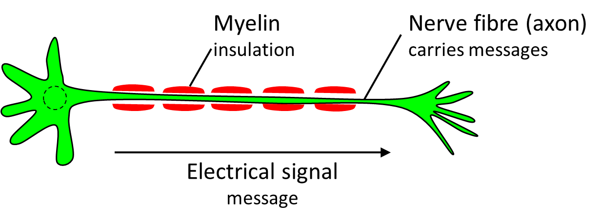 A healthy nerve cell is wrapped in a protective insulating sheath called myelin. 