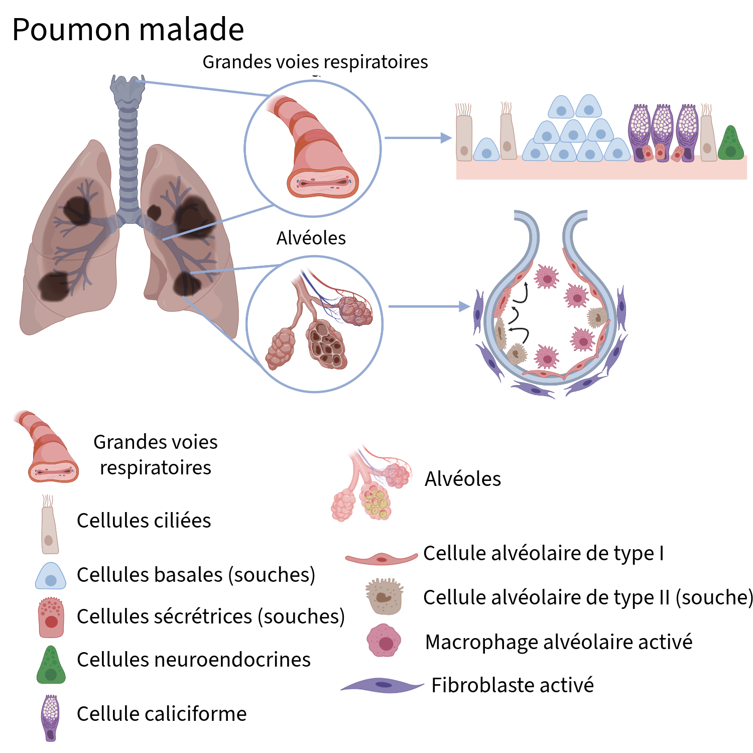 Diseased lung anatomy