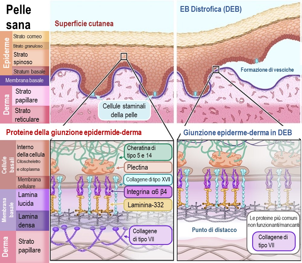 EB Distrofica