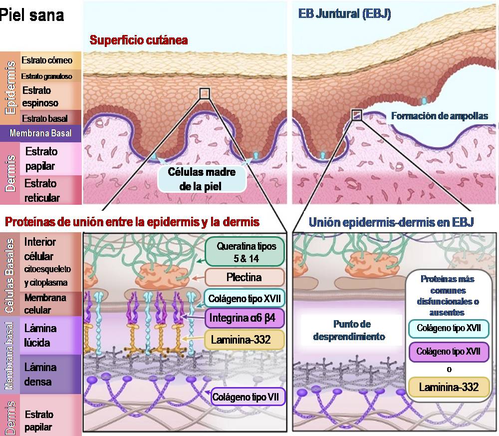 Ilustración 3: Esquema de piel sana en comparación con piel afectada por Epidermólisis Bullosa Juntural.