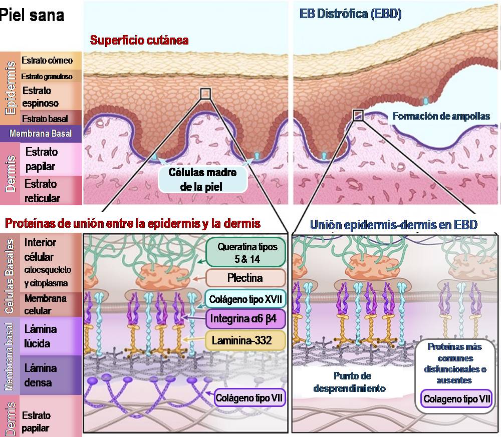 Ilustración 4: Esquema de piel sana en comparación con piel afectada por Epidermólisis Bullosa Distrófica.