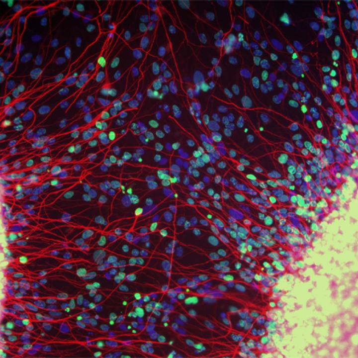 Motoneuron-Krankheit: wie können Stammzellen helfen?
