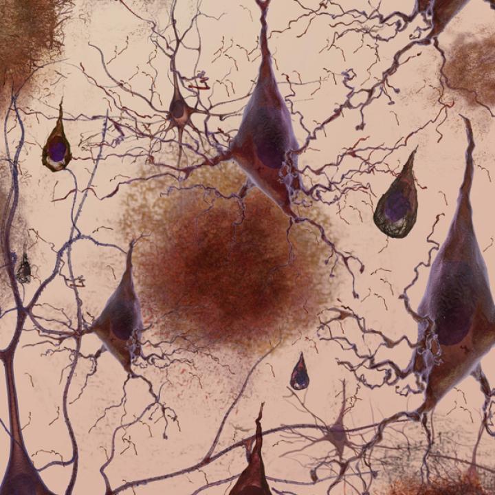 Choroba Alzheimera: w jaki sposób komórki macierzyste mogłyby pomóc?