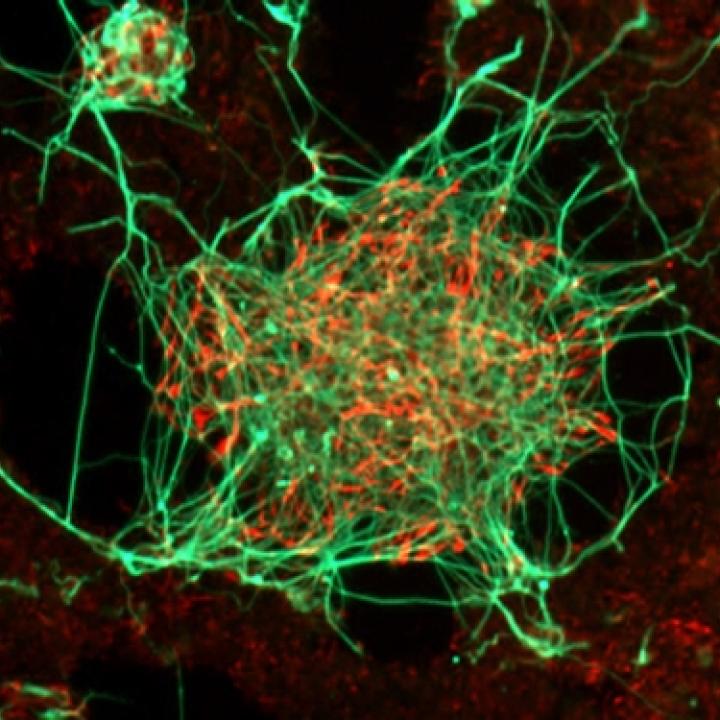 La malattia di Parkinson: come possono aiutare le cellule staminali?